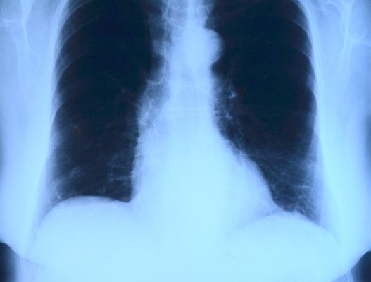 Causes des taches pulmonaires