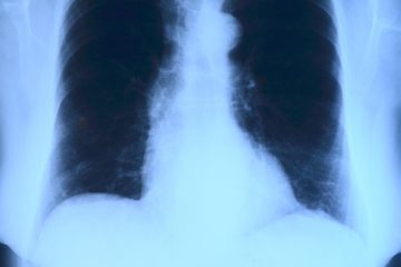 Qu'est-ce que la cicatrisation périhilaire des poumons ?