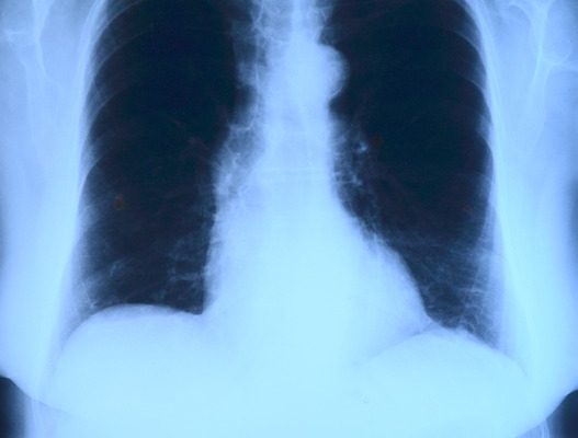 Qu'est-ce que la cicatrisation périhilaire des poumons ?