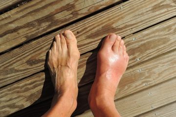 Symptômes de l'arthrite du pied