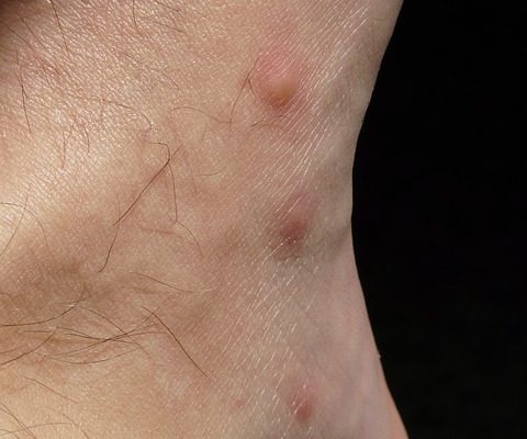 Quelles sont les causes des démangeaisons aux mains et aux pieds ?