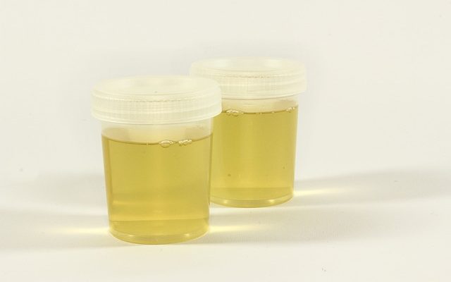 Quelle est l'importance de l'analyse d'urine ?