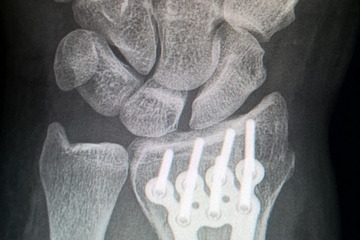 Stimulateur de croissance osseuse pour la cicatrisation des fractures