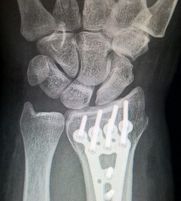 Stimulateur de croissance osseuse pour la cicatrisation des fractures