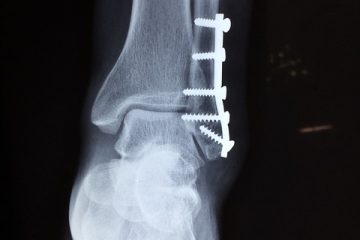 À propos de la guérison d'une fracture du péroné