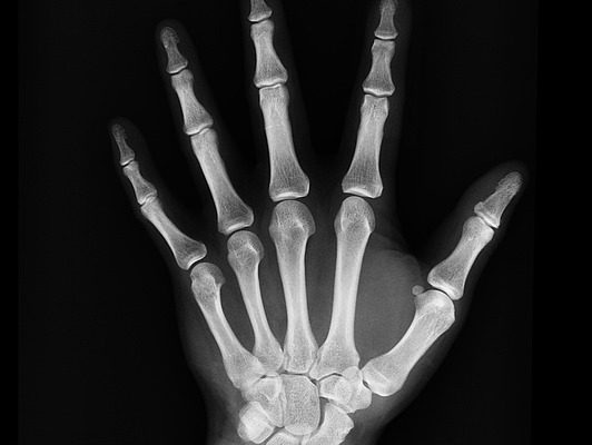 Comment se débarrasser des rayons X