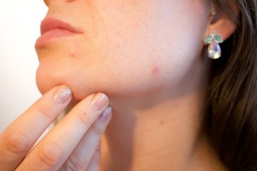 La néosporine peut-elle aider à guérir les cicatrices d'acné ?