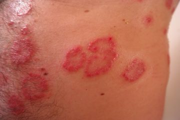 Aliments à manger avec psoriasis