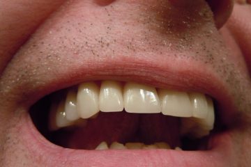 Problèmes de couronne dentaire