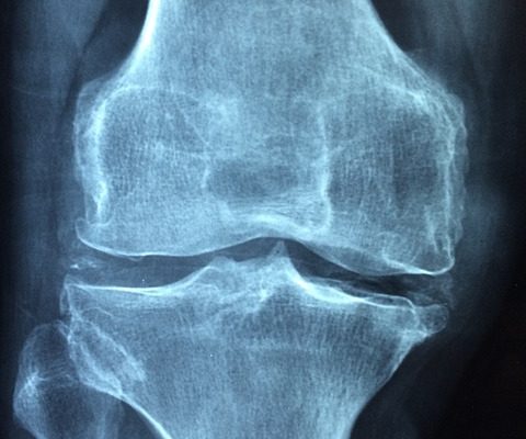 Cancer des os Symptômes du genou