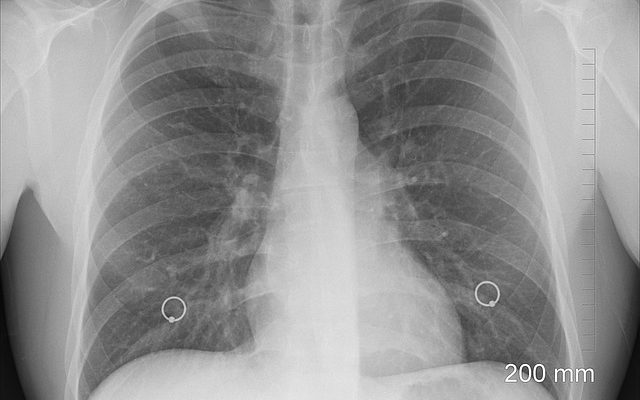 Les avantages de la radiographie