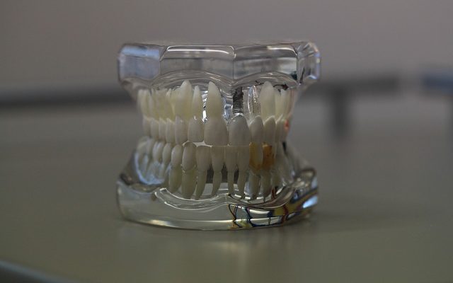 Que puis-je utiliser pour coller une dent sur une prothèse dentaire ?